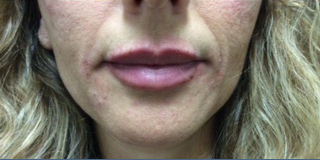 Fillers After Front View Patient 3 Dr. Sheryl D. Clark, M.D.