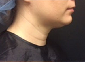 Kybella After Right Side View Patient 2 Dr. Sheryl D. Clark, M.D.
