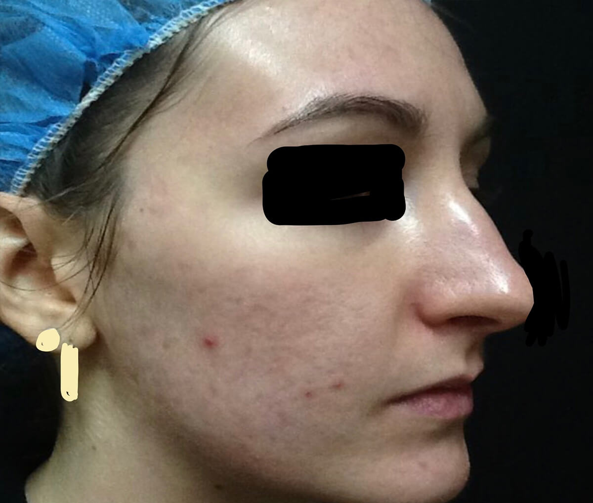 Patient Scar Face After Image
