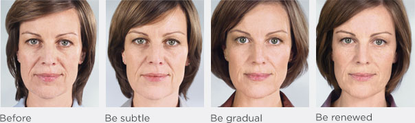 Stock Image of Model with Sculptra Results