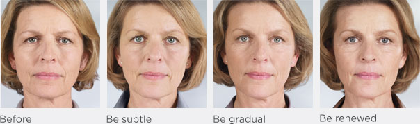 Stock Image of Model with Sculptra Results