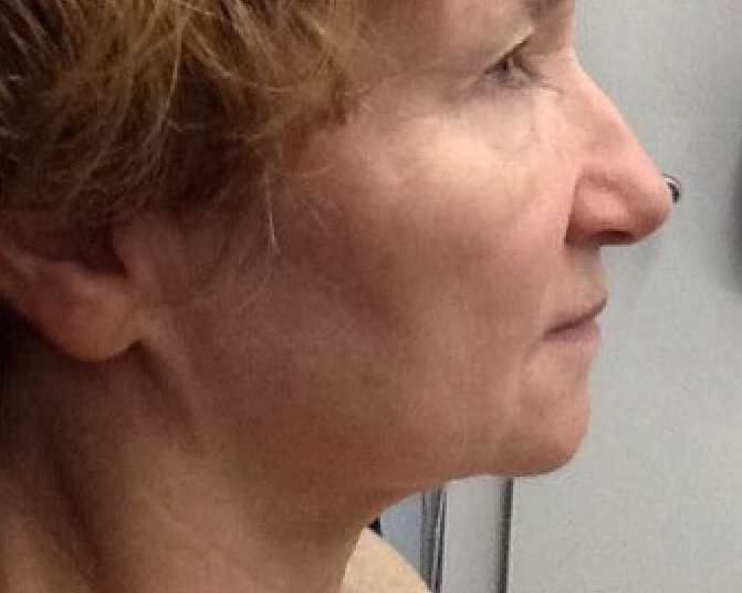 Ultherapy After Right View Patient 1 Dr. Sheryl D. Clark, M.D.
