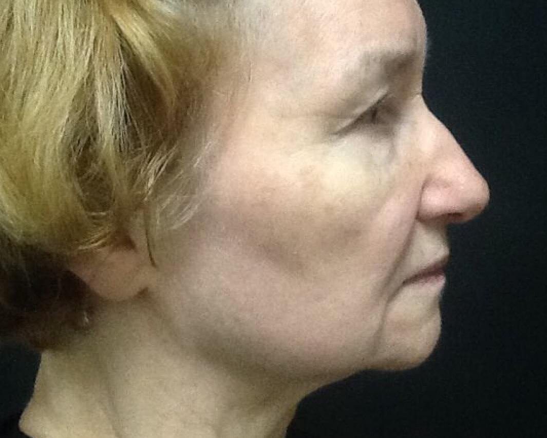 Ultherapy Before Right View Patient 1 Dr. Sheryl D. Clark, M.D.