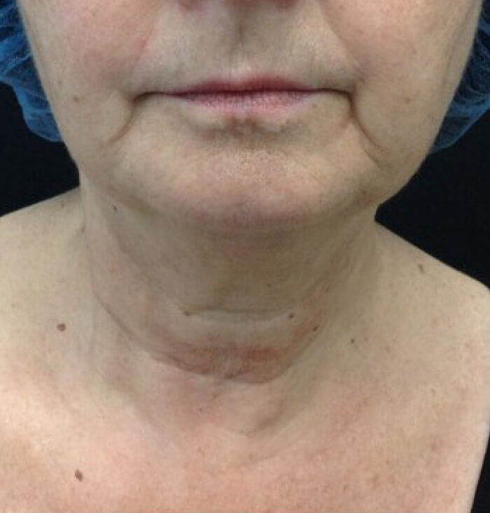 Ultherapy Before Front View Patient 2 Dr. Sheryl D. Clark, M.D.