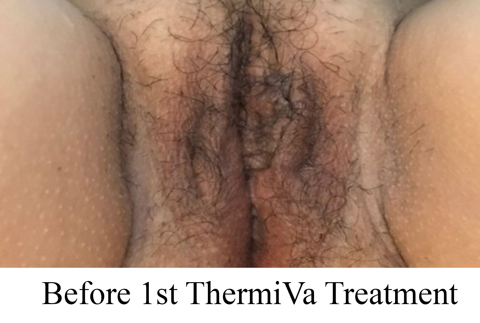 Before 1st ThermiVa Treatment
