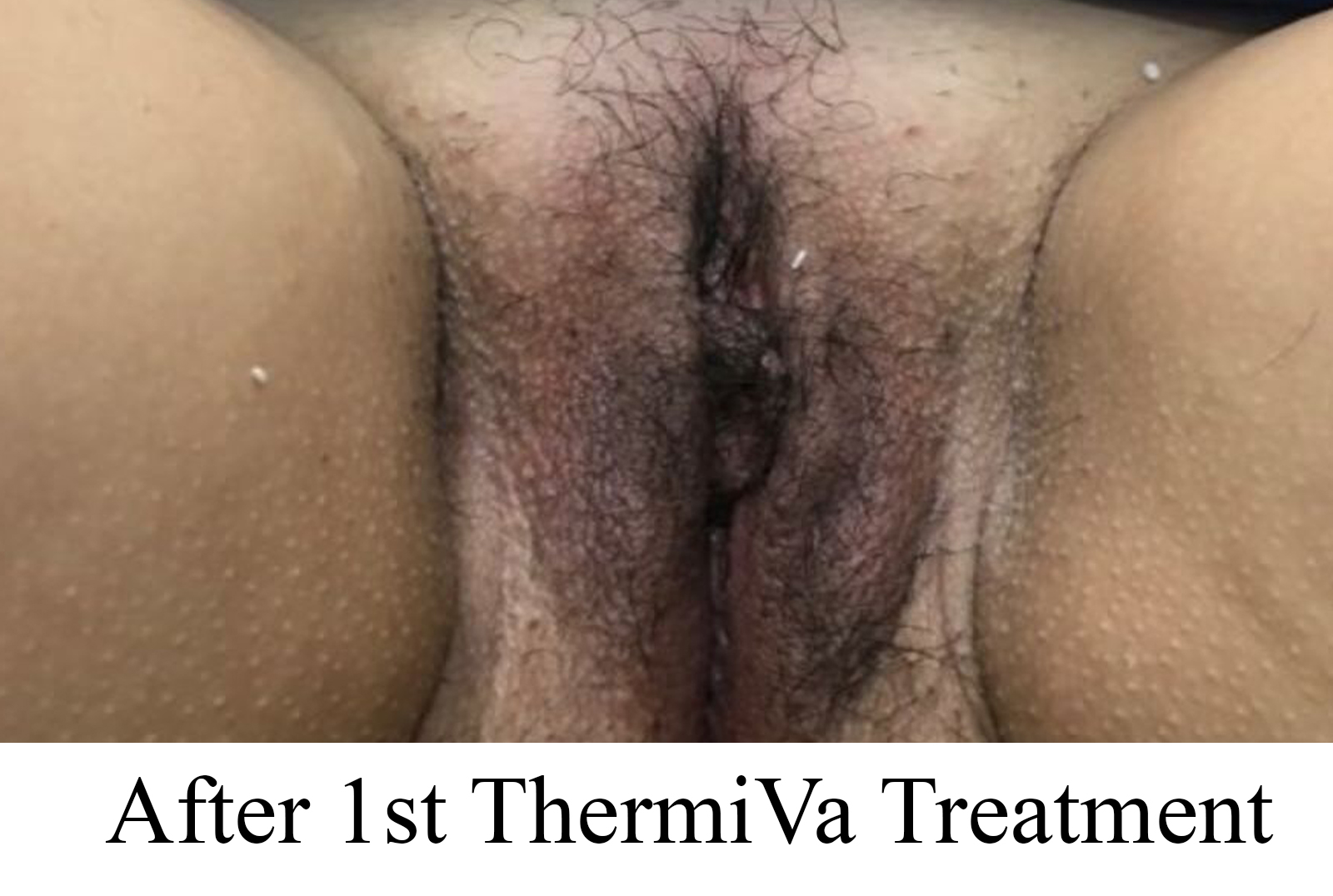 After 1st ThermiVa Treatment