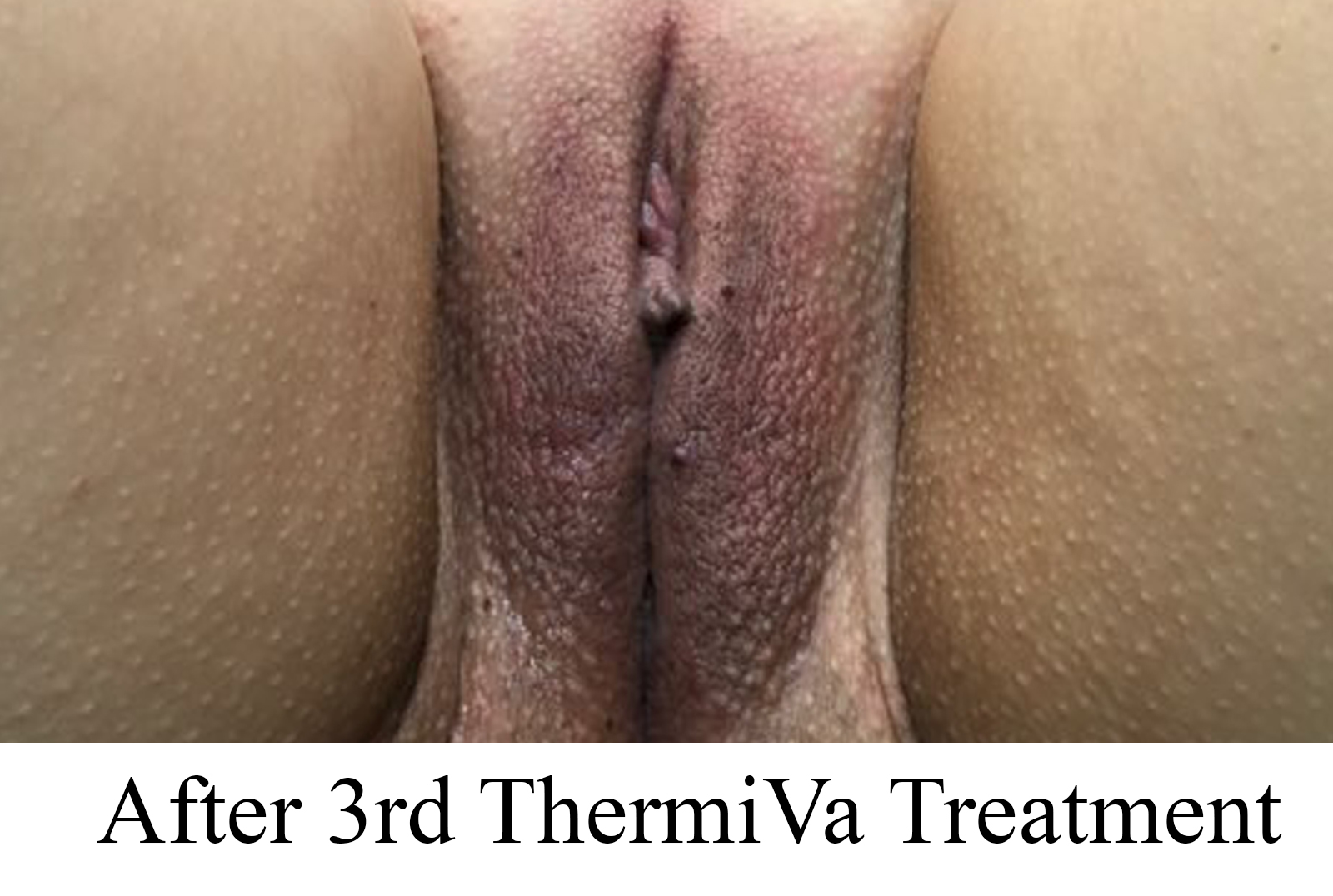 After 3rd ThermiVa Treatment