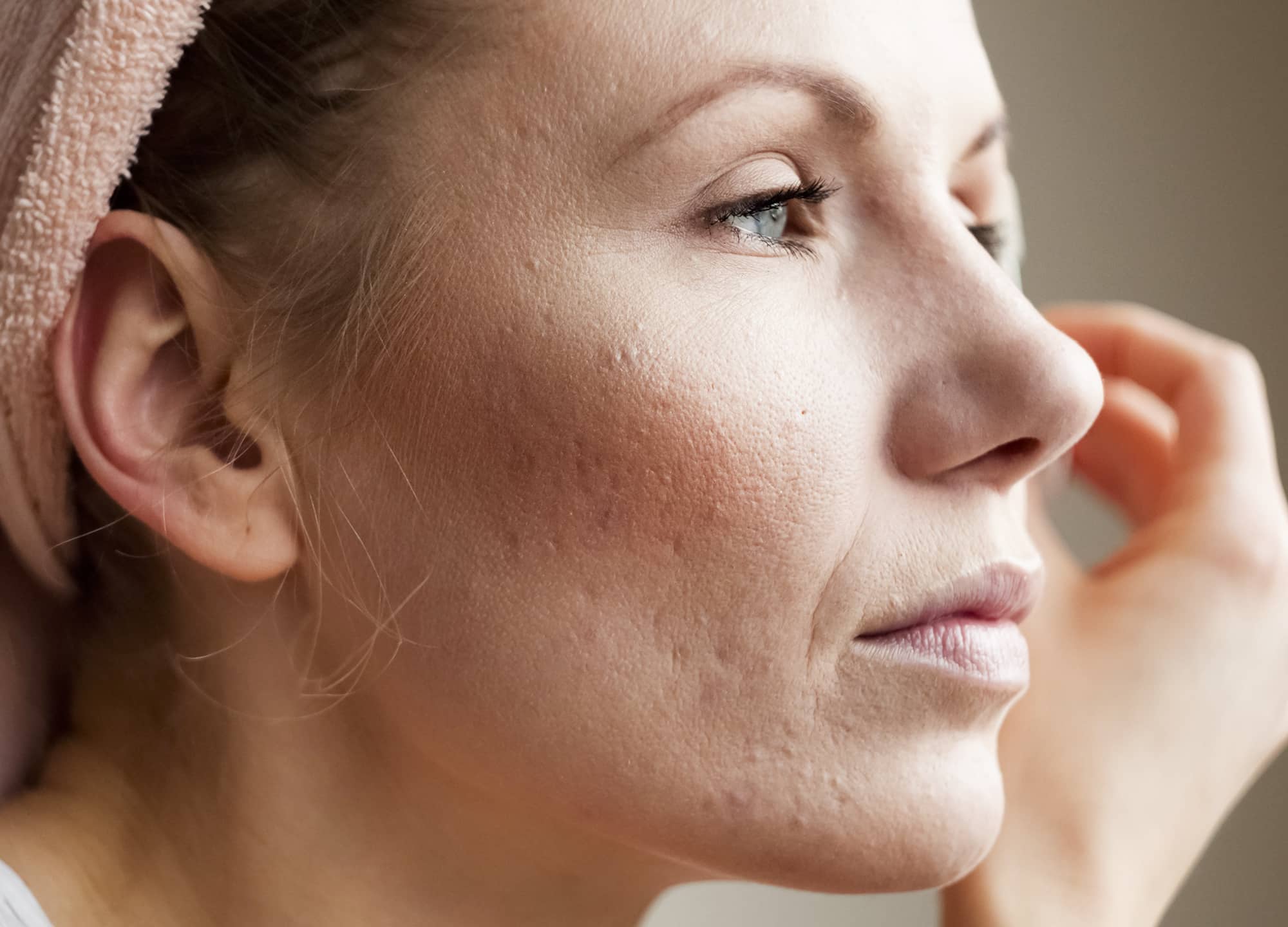 Stock image of Model after RS Sebacia acne treatment