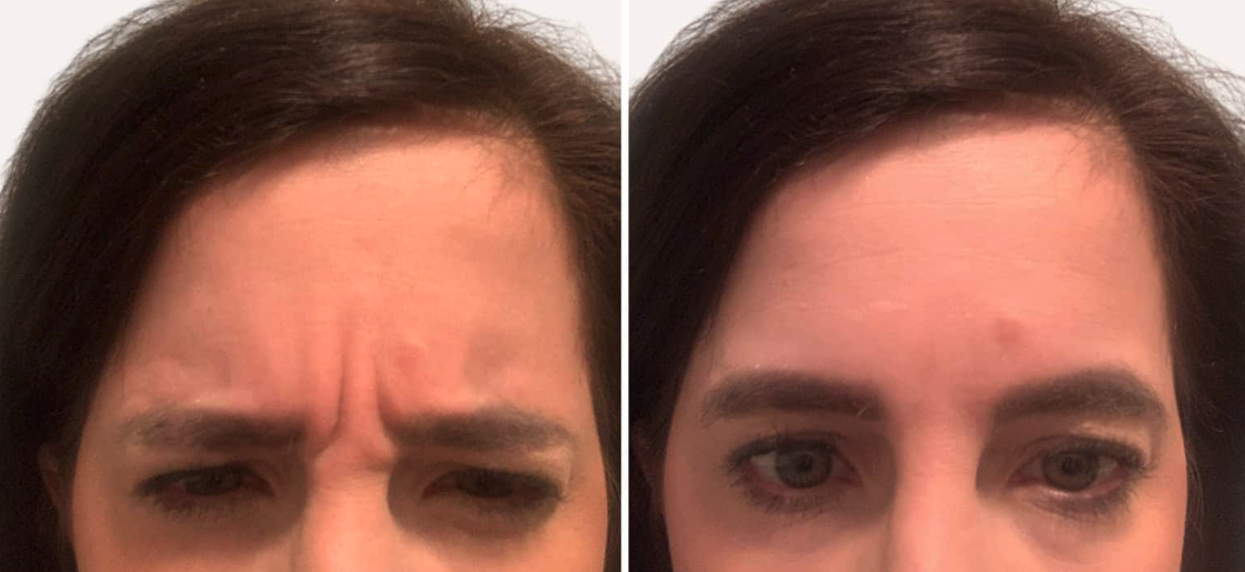 Before After image of Procedure Jeuveau