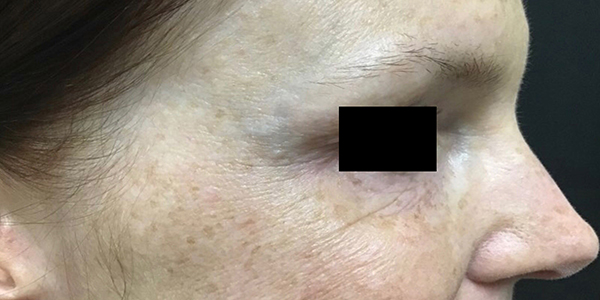 ThermiRF Before Right View Patient 6 Dr. Sheryl D. Clark, M.D.