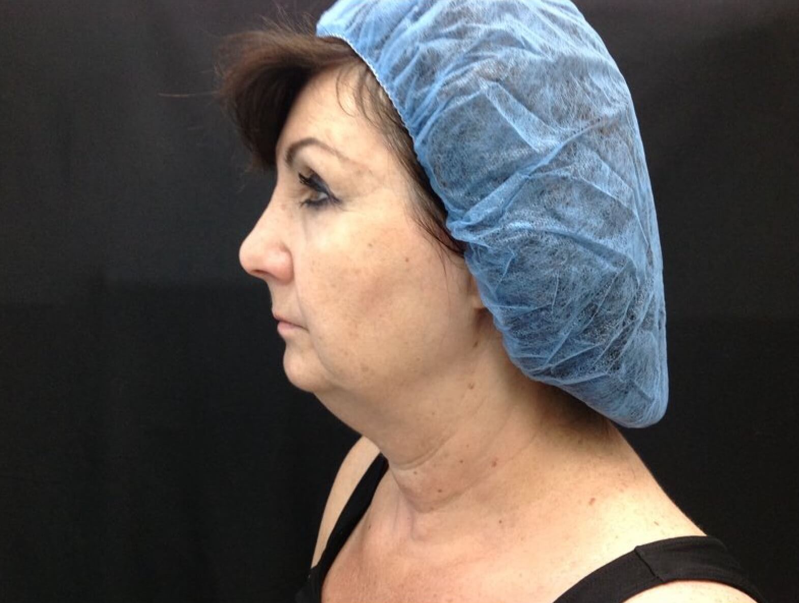 Ultherapy Before Left View Patient 3 Dr. Sheryl D. Clark, M.D.