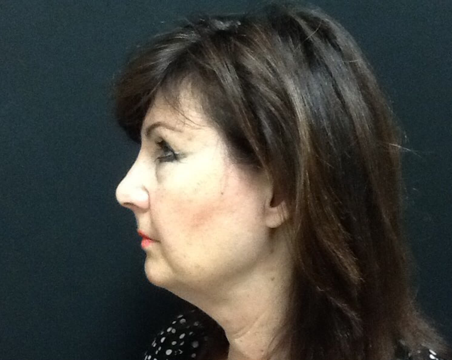 Ultherapy After Left View Patient 3 Dr. Sheryl D. Clark, M.D.