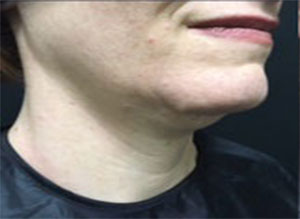 Kybella Before Right Side View Patient 1 Dr. Sheryl D. Clark, M.D.