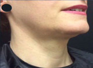 Kybella After Right Side View Patient 1 Dr. Sheryl D. Clark, M.D.