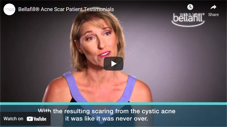 Bellafill® Acne Scar Patient Testimonials