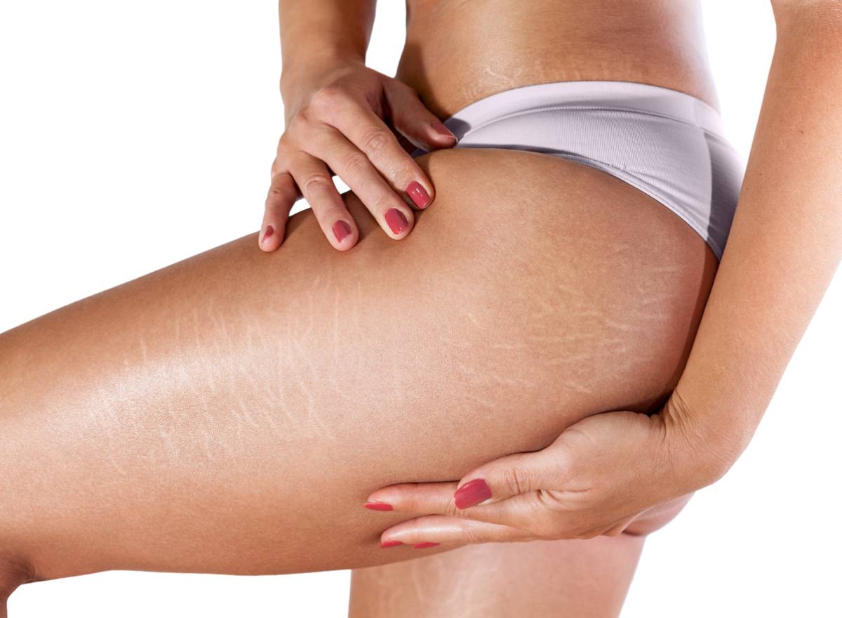 concept image of stretch marks on legs