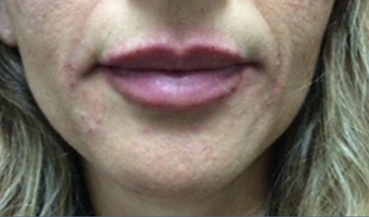 After image of lip fillers patient 4a