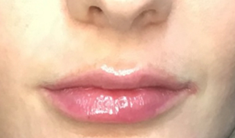 After image of lip fillers patient 1a