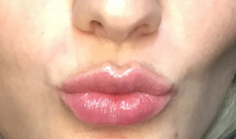 After image of lip fillers patient 1b
