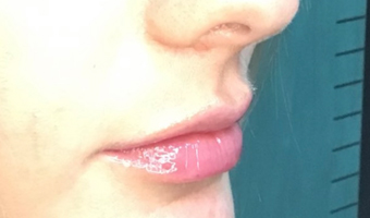 After image of lip fillers patient 1c