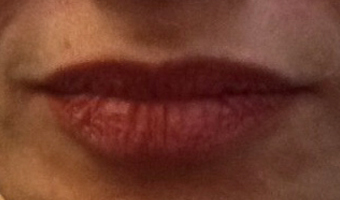 After image of lip fillers patient 3a