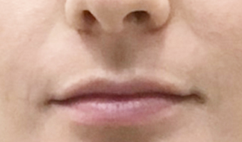 Before image of lip fillers patient 1a