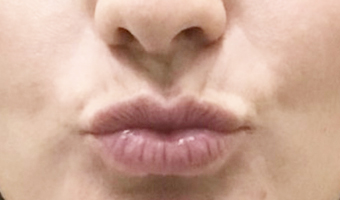 Before image of lip fillers patient 1b