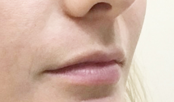 Before image of lip fillers patient 1c
