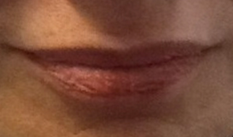 Before image of lip fillers patient 3a