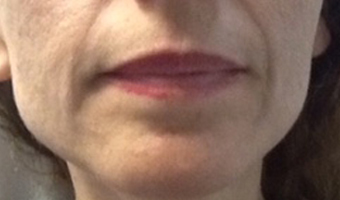 Before image of lip fillers patient 4a